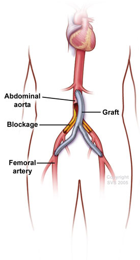 cpt code for vein patch angioplasty of brachial artery